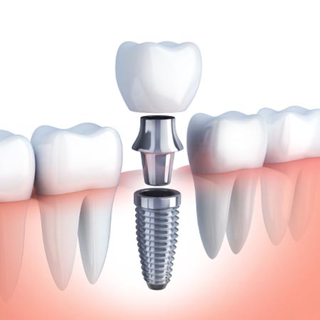 dental implants in Hyderabad